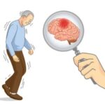 Parkinson-disease-7