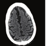 bleed brain