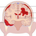 intracranial copy