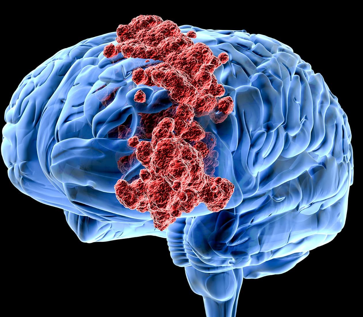 Brain and Spinal Cord Tumors Program Brain and Spinal Cord Tumors Program